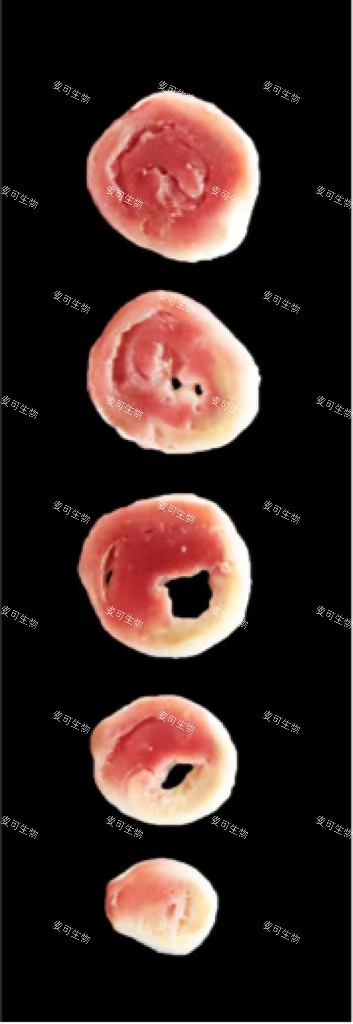 心肌梗死