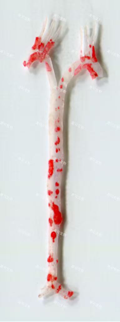 动脉粥样硬化