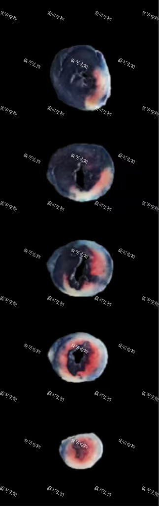 心肌梗死-2